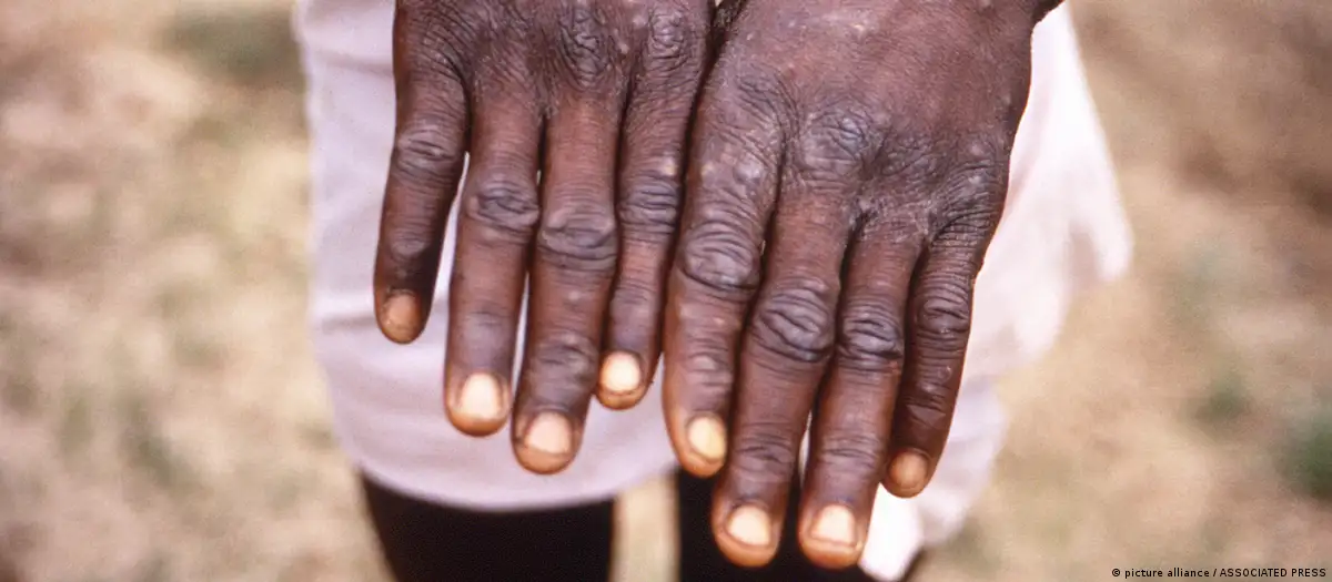 Mpox: Cabinda confirma 264 casos e duas mortes